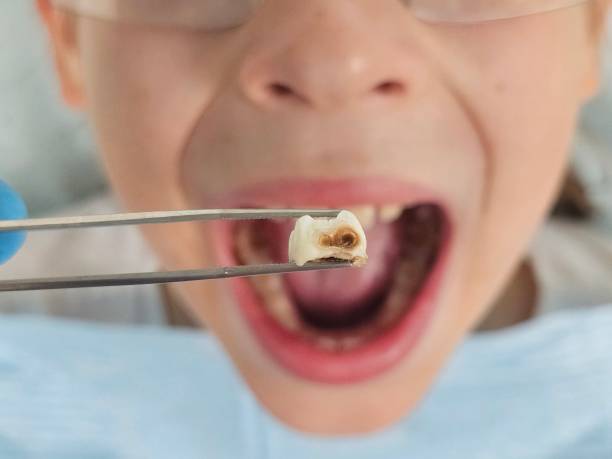 Best Knocked-Out Tooth (Avulsed Tooth) Treatment in Gibsonville, NC